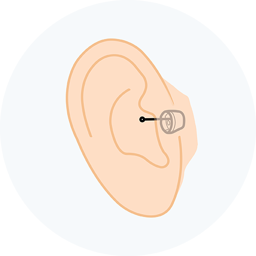 Completely-in-canal hearing aid illustration